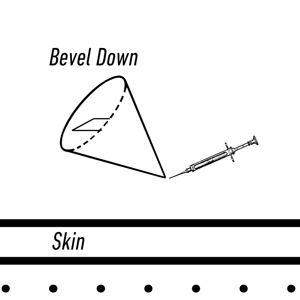 graphic showing the bevel down on the insulin syringe entering the skin first.